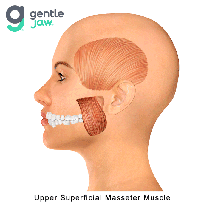 Muscle-Referral-Patterns-Superficial-Masseter-Upper.gif