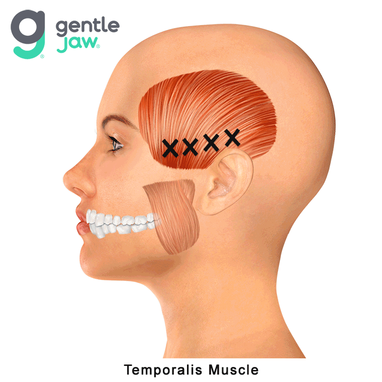Muscle-Referral-Patterns-Temporalis10.gif
