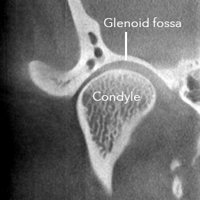 TMJ Radiology for Beverly Hills TMJ Osteoarthritis TMD TMJD