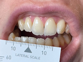 TMJ Animation Images Developed by Dr. Rich Hirschinger and Range of Motion