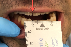 TMJ Animation Images Developed by Dr. Rich Hirschinger and Range of Motion