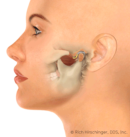 2024-Rich-Hirschinger-TMJ-Jaw-Popping