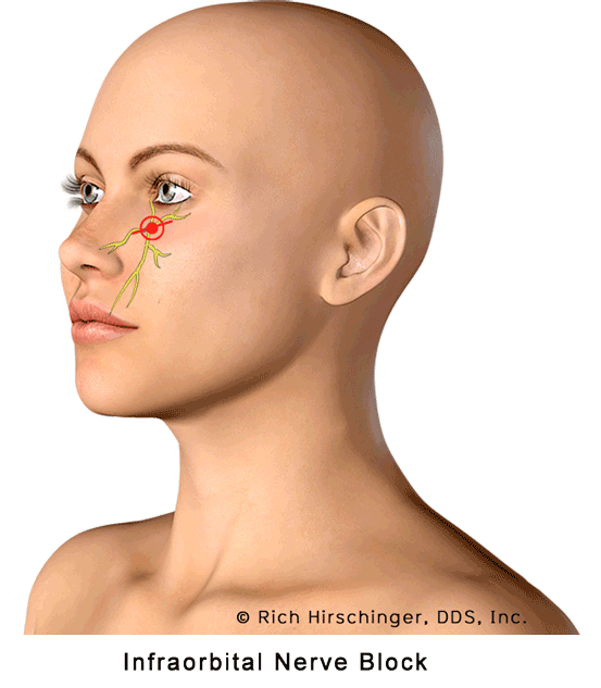 Infraorbital Nerve Block