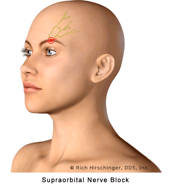 Supraorbital Nerve Block