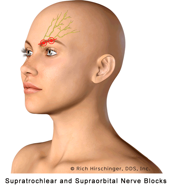 Supratrochlear and Supraorbital Nerve Blocks