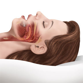 sleep apnea